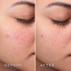 Medik8 Press & Clear Refill | Refillable BHA Toner for Problem Skin 150 ml